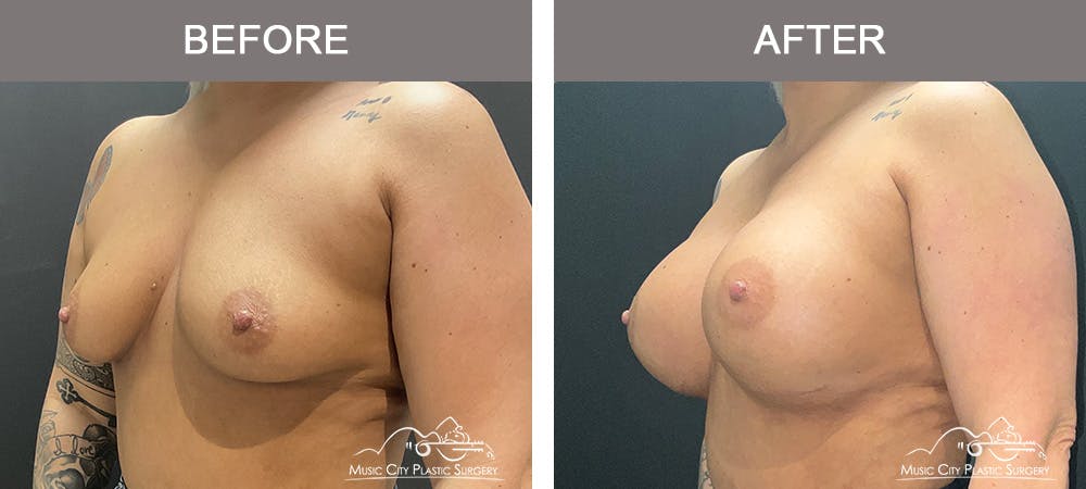 Breast Augmentation Before & After Gallery - Patient 346921 - Image 2