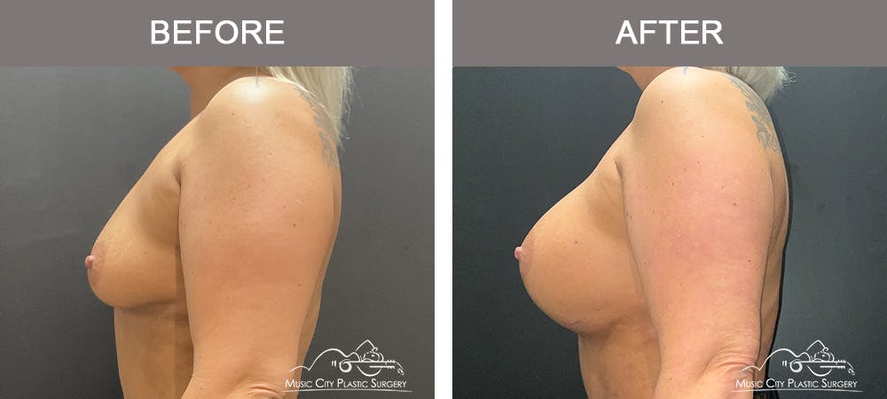 Breast Augmentation Before & After Gallery - Patient 346921 - Image 3