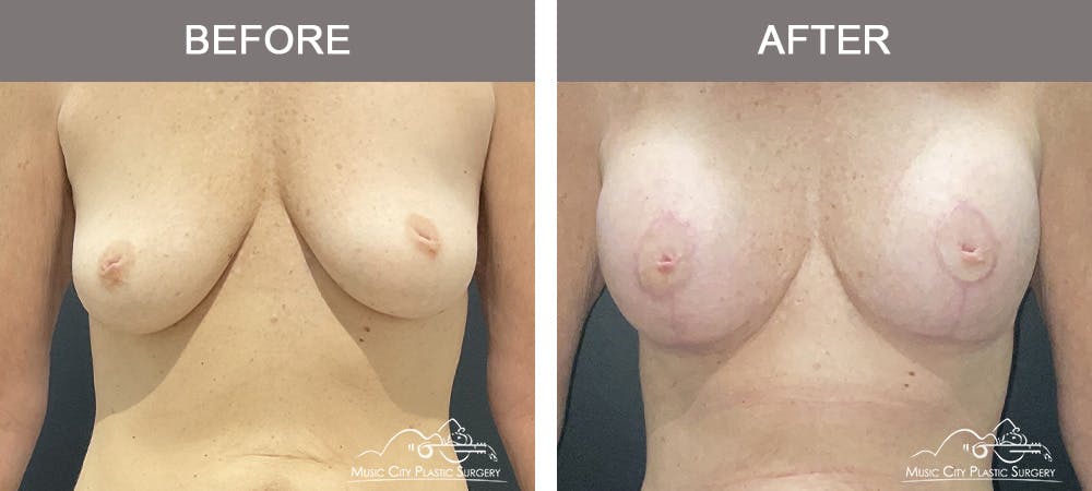Breast Augmentation Before & After Gallery - Patient 214663 - Image 1