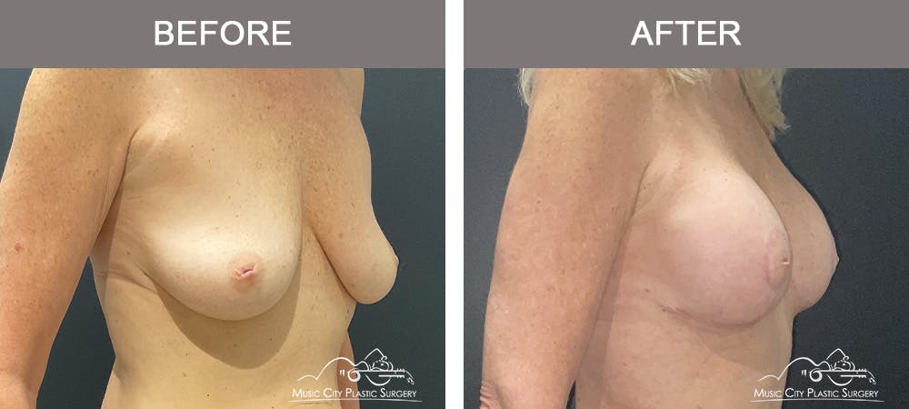 Breast Augmentation Before & After Gallery - Patient 214663 - Image 2