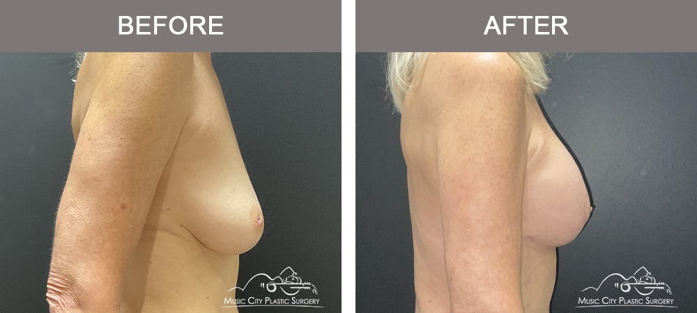 Breast Augmentation Before & After Gallery - Patient 214663 - Image 3