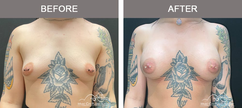 Breast Augmentation Before & After Gallery - Patient 195357 - Image 1