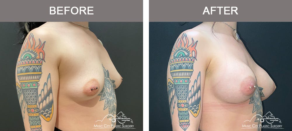 Breast Augmentation Before & After Gallery - Patient 195357 - Image 2