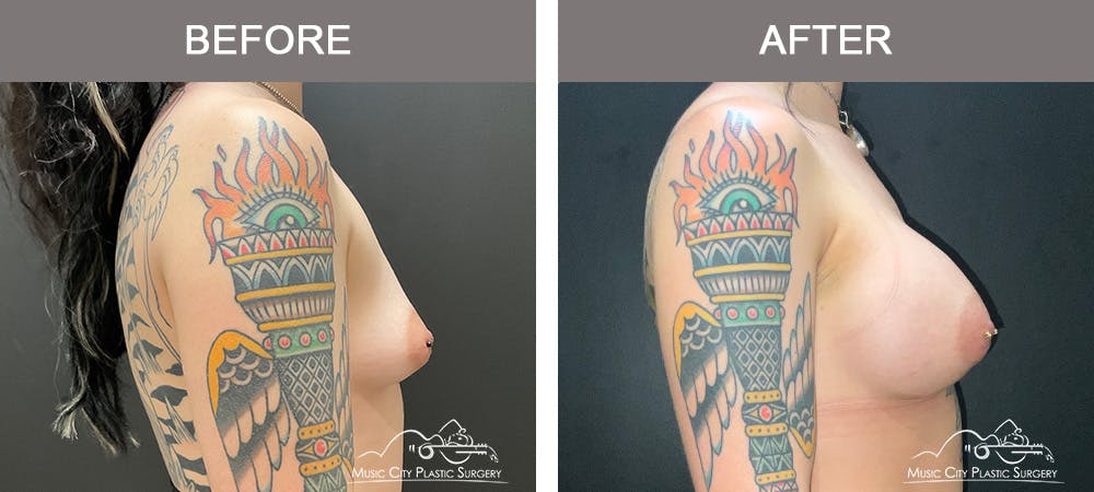 Breast Augmentation Before & After Gallery - Patient 195357 - Image 3