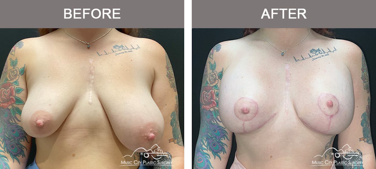Breast Augmentation Before & After Gallery - Patient 376543 - Image 1