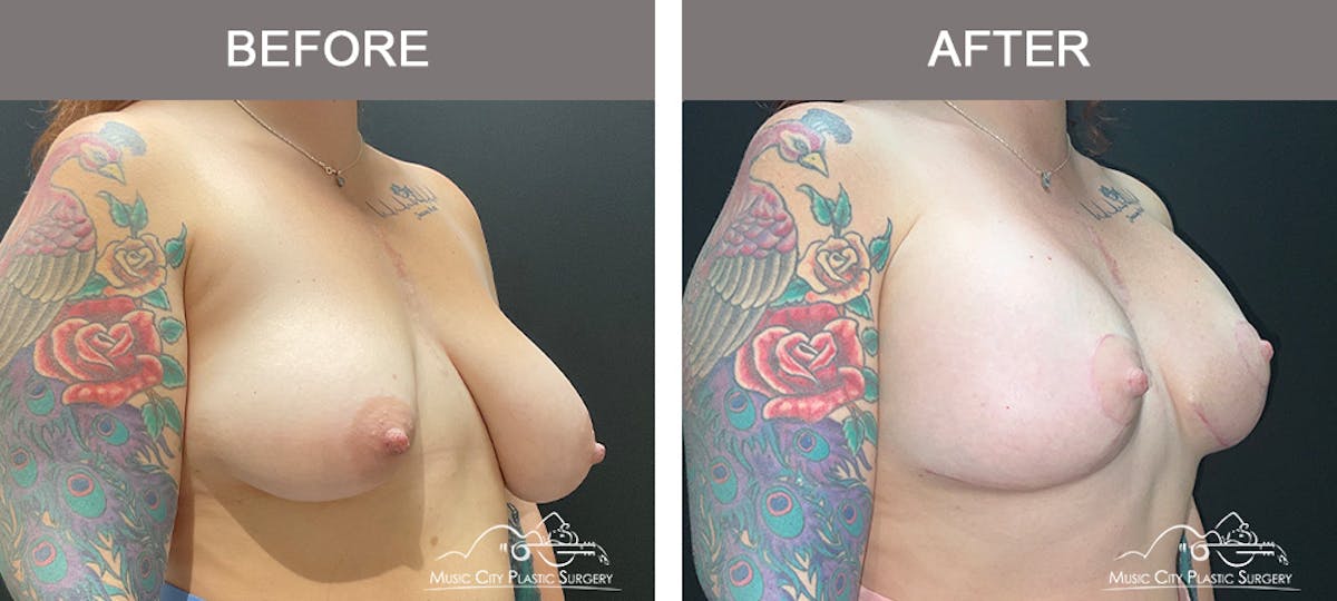 Breast Augmentation Before & After Gallery - Patient 376543 - Image 2