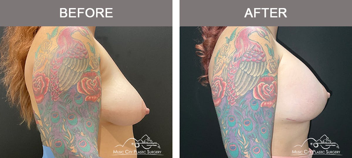 Breast Augmentation Before & After Gallery - Patient 376543 - Image 3