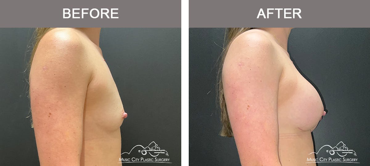 Breast Augmentation Before & After Gallery - Patient 385636 - Image 3