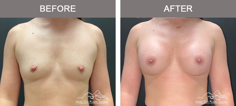 Breast Augmentation Before & After Gallery - Patient 385636 - Image 1
