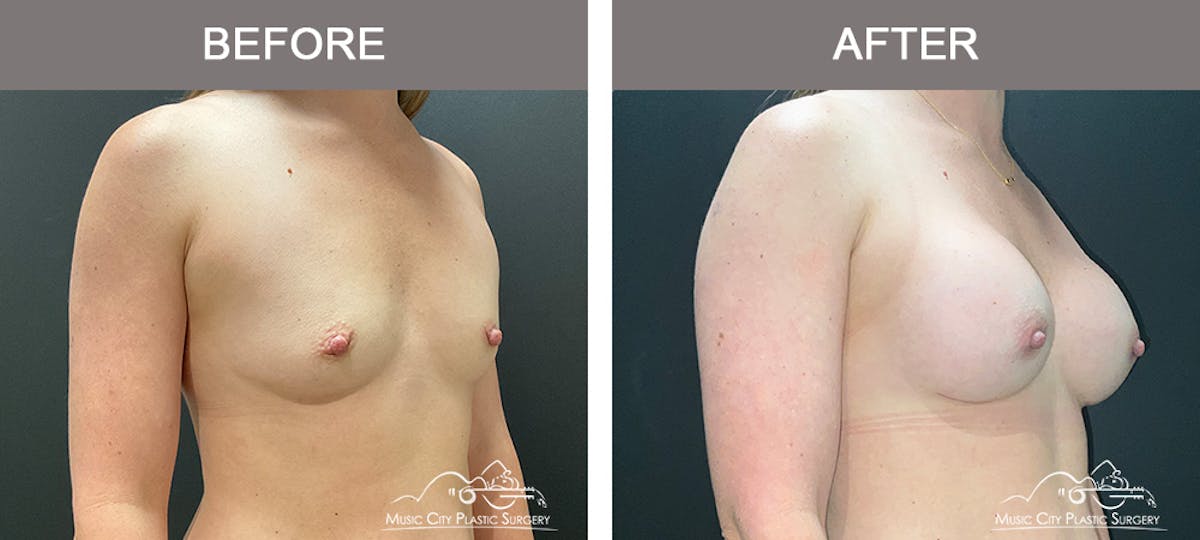 Breast Augmentation Before & After Gallery - Patient 385636 - Image 2