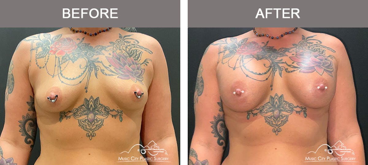 Breast Augmentation Before & After Gallery - Patient 124823 - Image 1