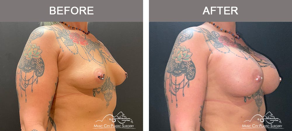 Breast Augmentation Before & After Gallery - Patient 124823 - Image 2