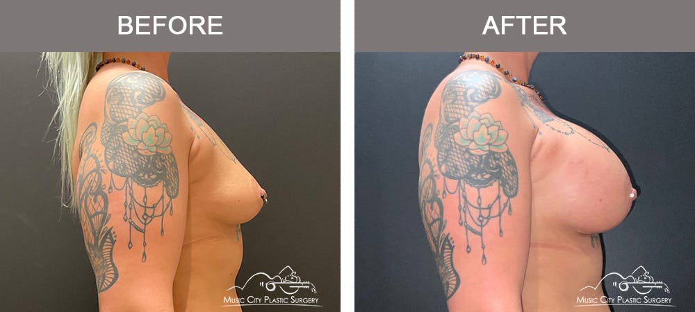 Breast Augmentation Before & After Gallery - Patient 124823 - Image 3