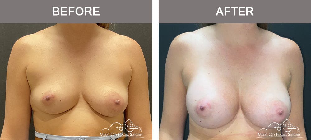 Breast Augmentation Before & After Gallery - Patient 259033 - Image 1