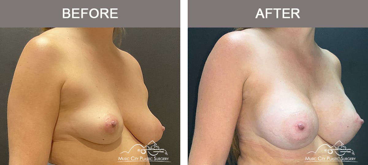Breast Augmentation Before & After Gallery - Patient 259033 - Image 2