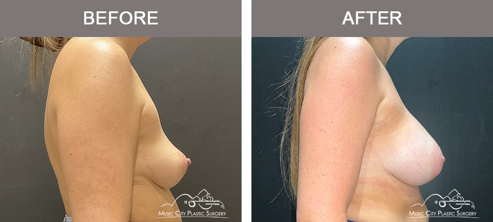 Breast Augmentation Before & After Gallery - Patient 259033 - Image 3