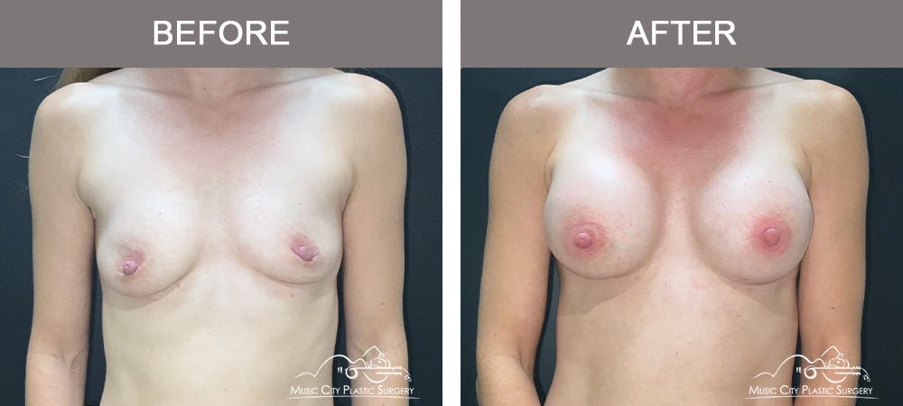 Breast Augmentation Before & After Gallery - Patient 340823 - Image 1