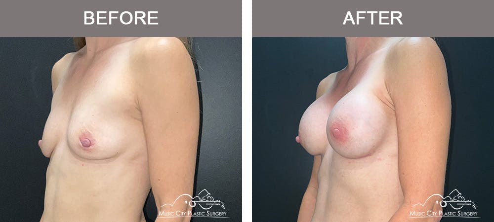Breast Augmentation Before & After Gallery - Patient 340823 - Image 2