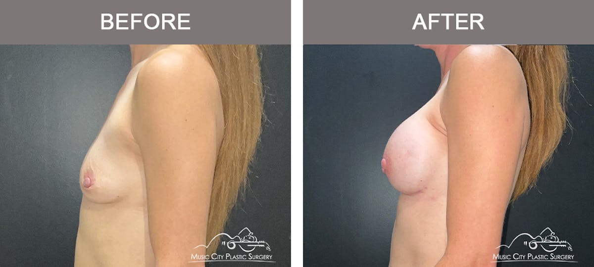 Breast Augmentation Before & After Gallery - Patient 340823 - Image 3