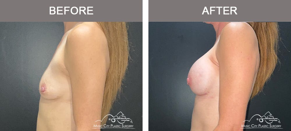 Breast Augmentation Before & After Gallery - Patient 340823 - Image 3
