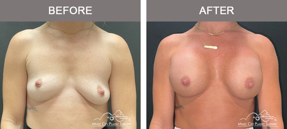 Breast Augmentation Before & After Gallery - Patient 390467 - Image 1