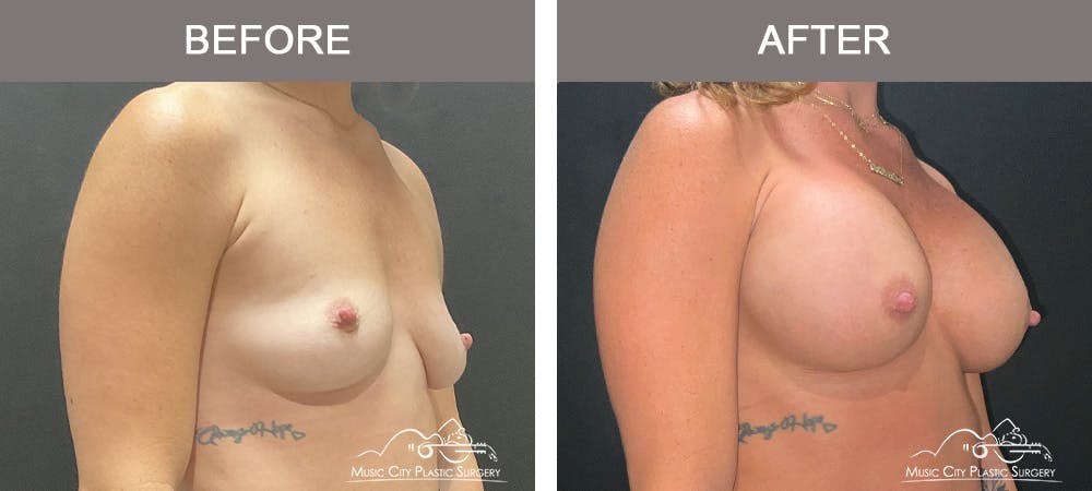Breast Augmentation Before & After Gallery - Patient 390467 - Image 2