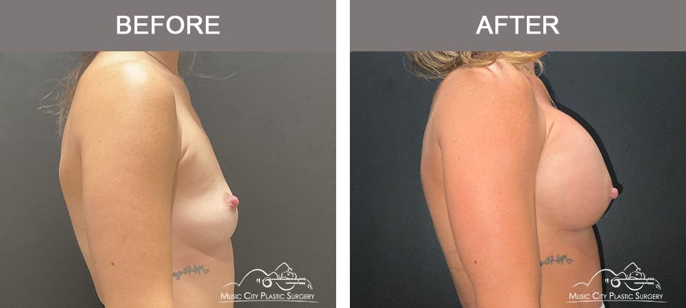 Breast Augmentation Before & After Gallery - Patient 390467 - Image 3
