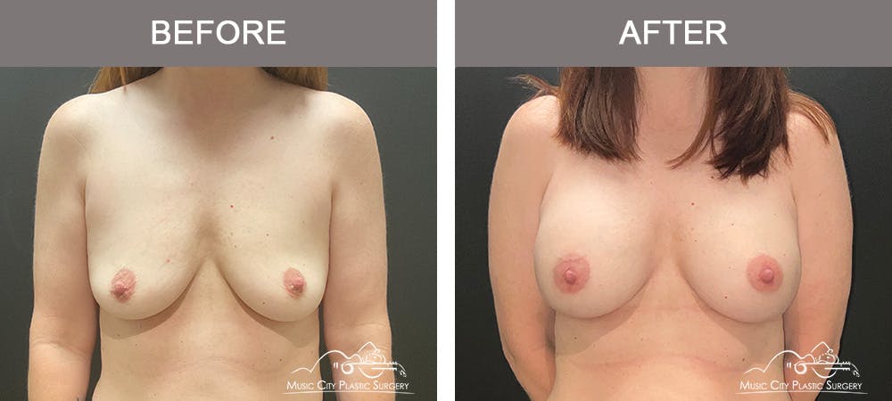 Breast Augmentation Before & After Gallery - Patient 236091 - Image 1