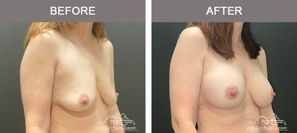 Breast Augmentation Before & After Gallery - Patient 236091 - Image 2