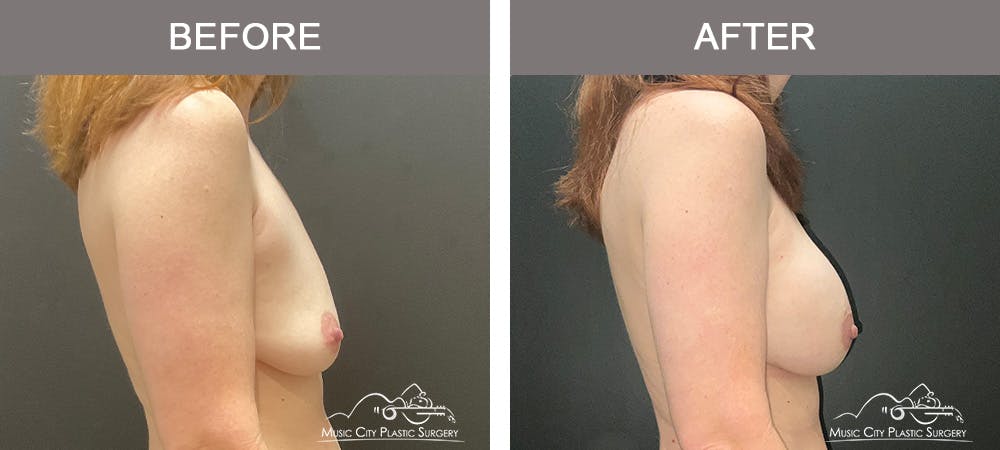 Breast Augmentation Before & After Gallery - Patient 236091 - Image 3