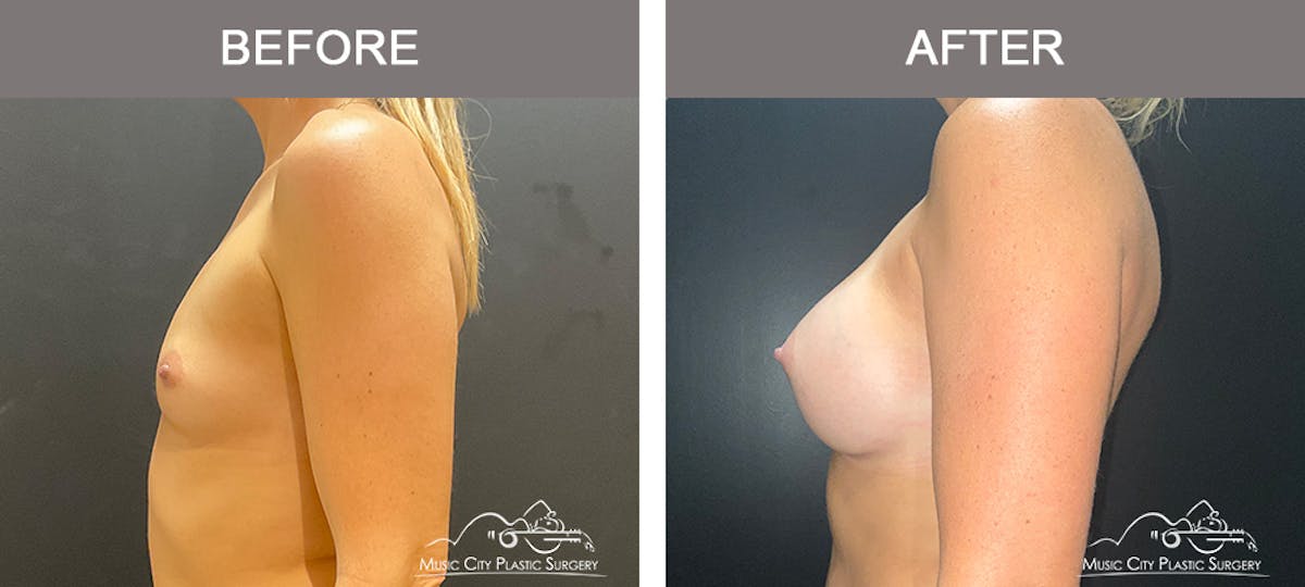 Breast Augmentation Before & After Gallery - Patient 126833 - Image 3
