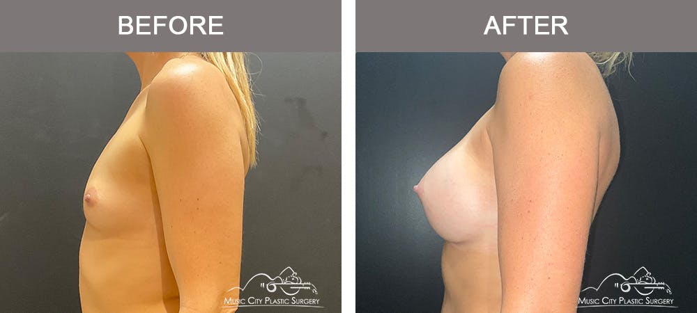Breast Augmentation Before & After Gallery - Patient 126833 - Image 3