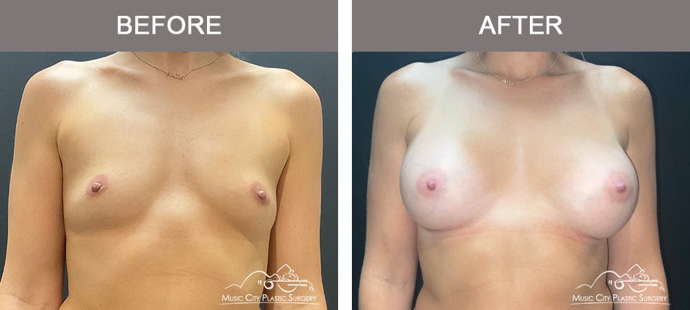 Breast Augmentation Before & After Gallery - Patient 126833 - Image 1