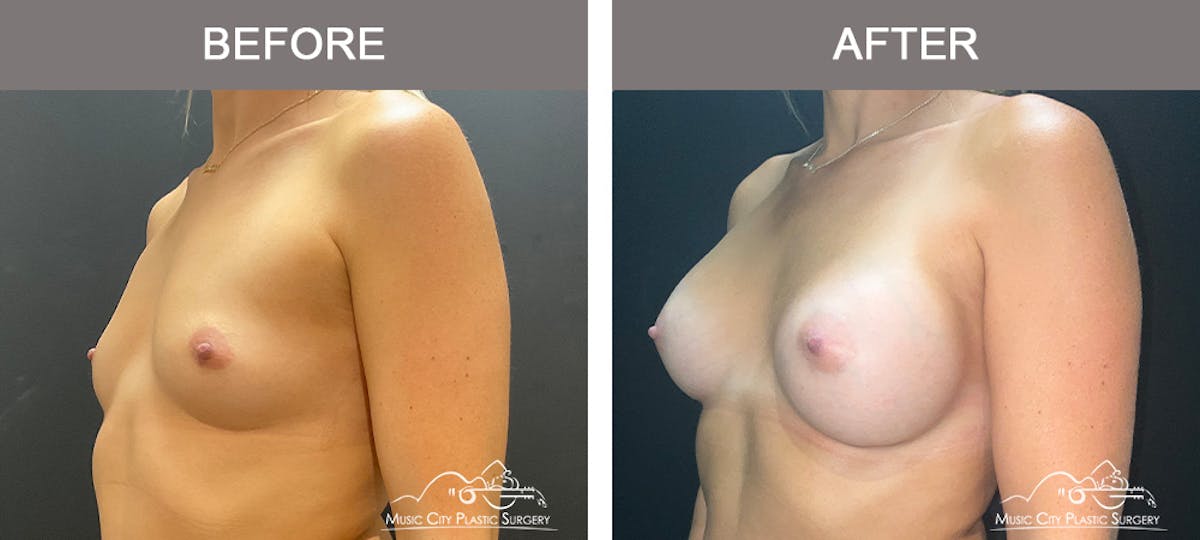 Breast Augmentation Before & After Gallery - Patient 126833 - Image 2