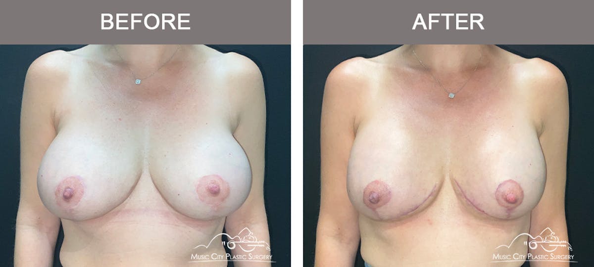 Implant Exchange Before & After Gallery - Patient 108734 - Image 1