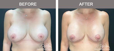 Implant Exchange Before & After Gallery - Patient 108734 - Image 1