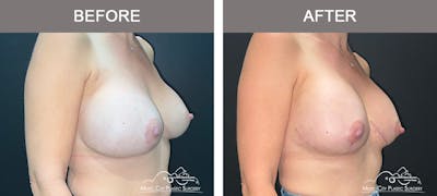 Implant Exchange Before & After Gallery - Patient 108734 - Image 2