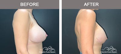 Implant Exchange Before & After Gallery - Patient 108734 - Image 3