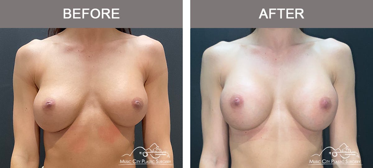 Implant Exchange Before & After Gallery - Patient 135171 - Image 1