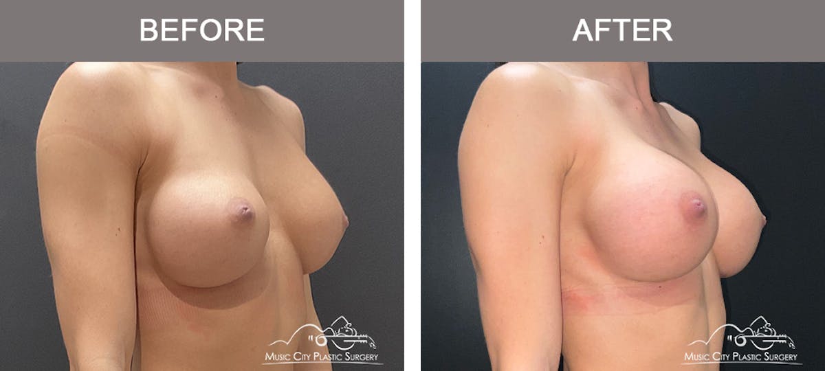 Implant Exchange Before & After Gallery - Patient 135171 - Image 2