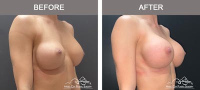 Implant Exchange Before & After Gallery - Patient 135171 - Image 2