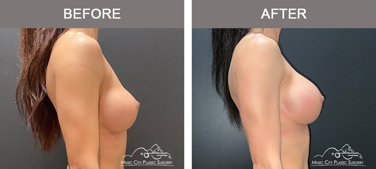 Implant Exchange Before & After Gallery - Patient 135171 - Image 3
