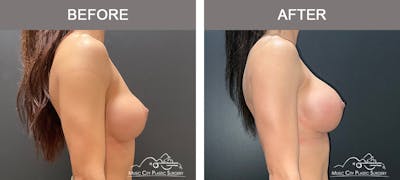 Implant Exchange Before & After Gallery - Patient 135171 - Image 3