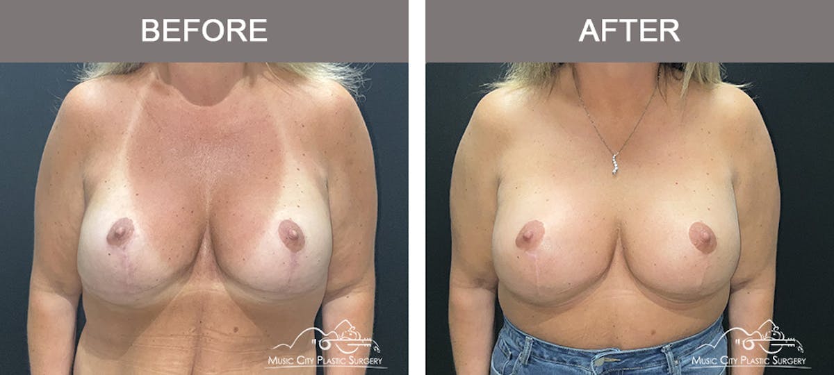 Implant Exchange Before & After Gallery - Patient 351585 - Image 1