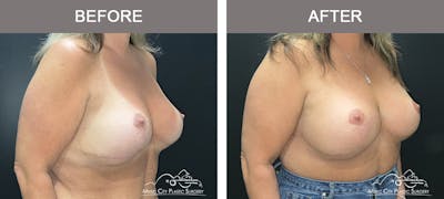 Implant Exchange Before & After Gallery - Patient 351585 - Image 2