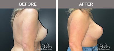 Implant Exchange Before & After Gallery - Patient 351585 - Image 3