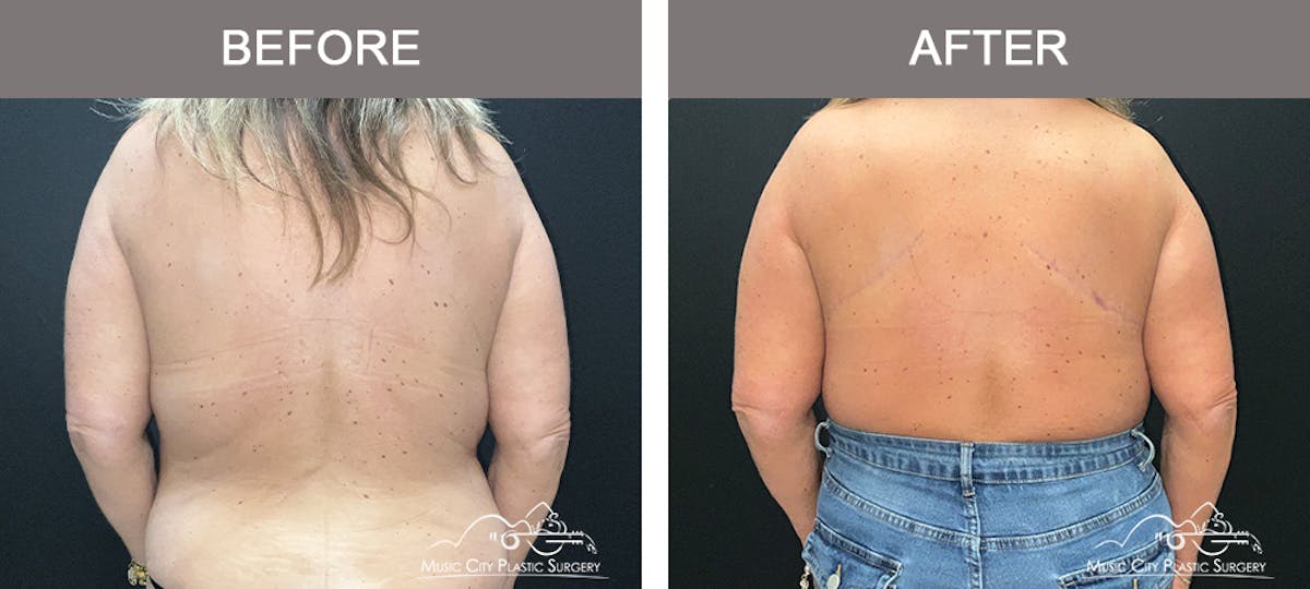 Implant Exchange Before & After Gallery - Patient 351585 - Image 4