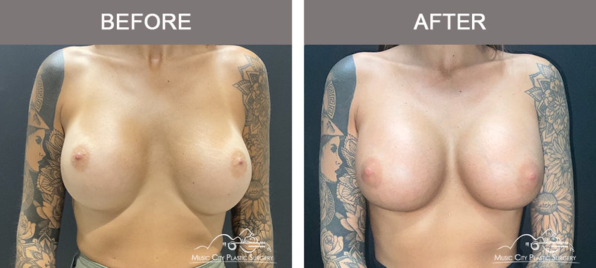 Implant Exchange Before & After Gallery - Patient 384545 - Image 1