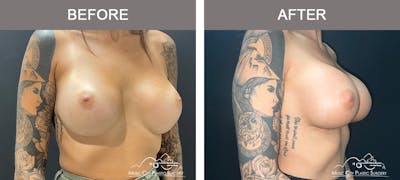 Implant Exchange Before & After Gallery - Patient 384545 - Image 2