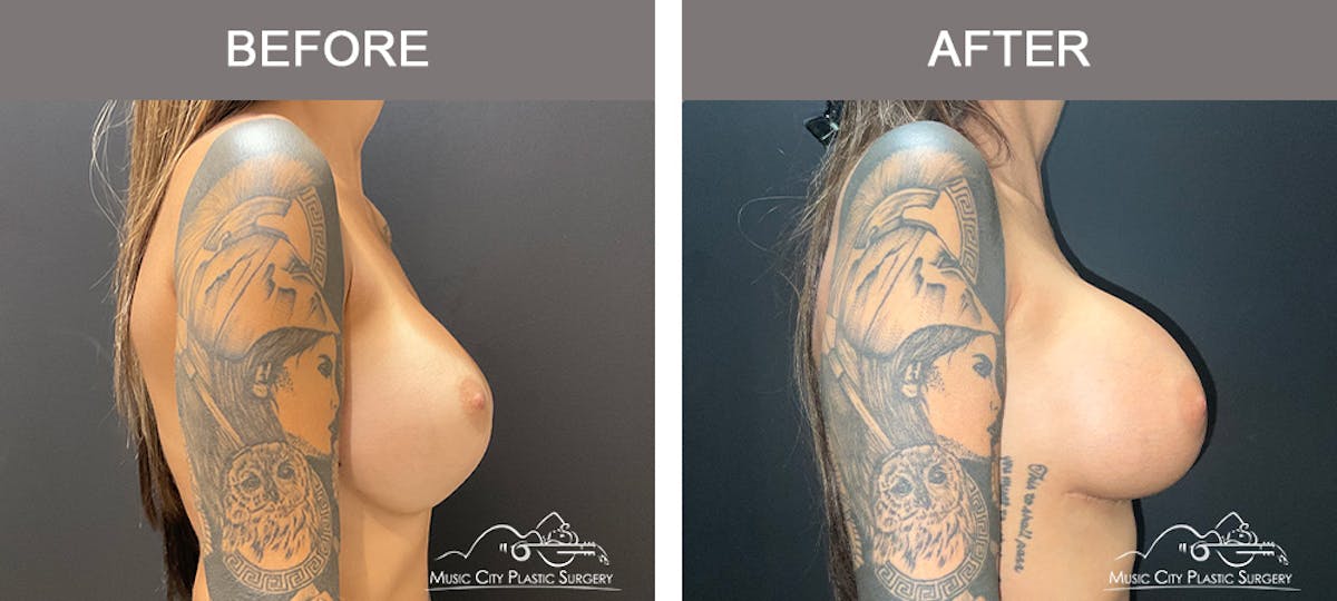 Implant Exchange Before & After Gallery - Patient 384545 - Image 3